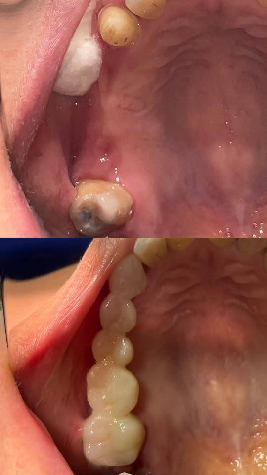Diente con caries y dientes posteriores restaurados en el caso de la prótesis fija.